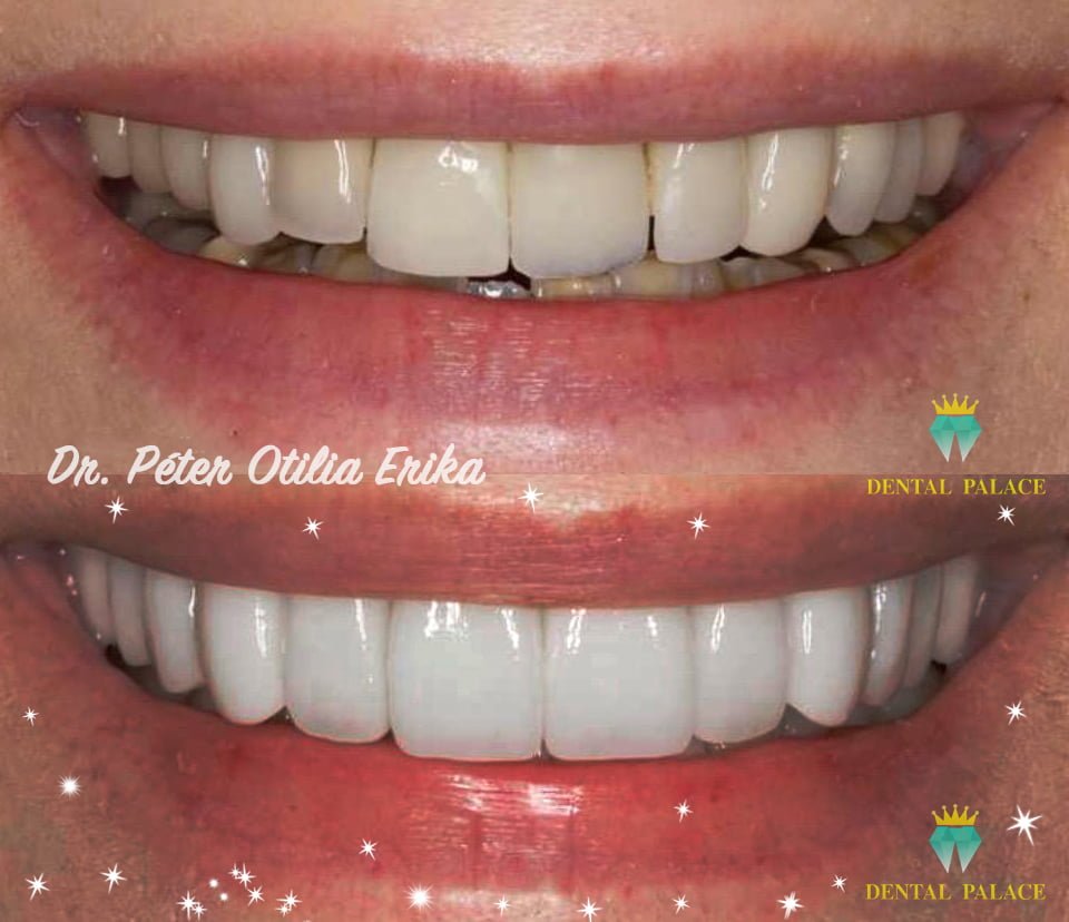 fatete-dentare-aspect-natural-1
